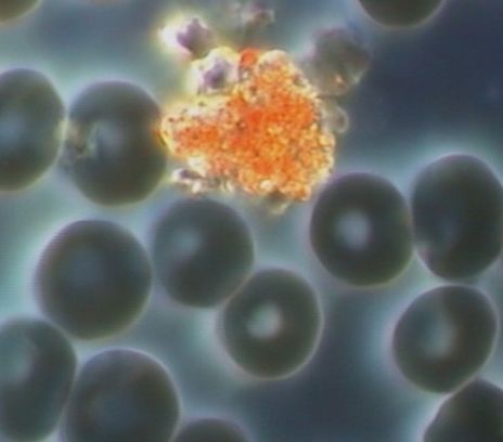 Aggregato arancione fra gli eritrociti osservato in campo oscuro
