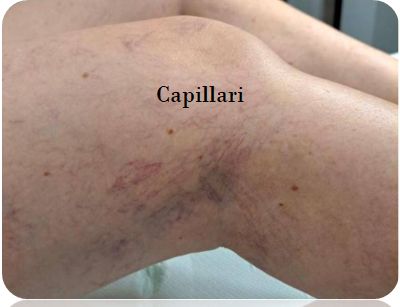 Capillari e teleangectasie sul ginocchio