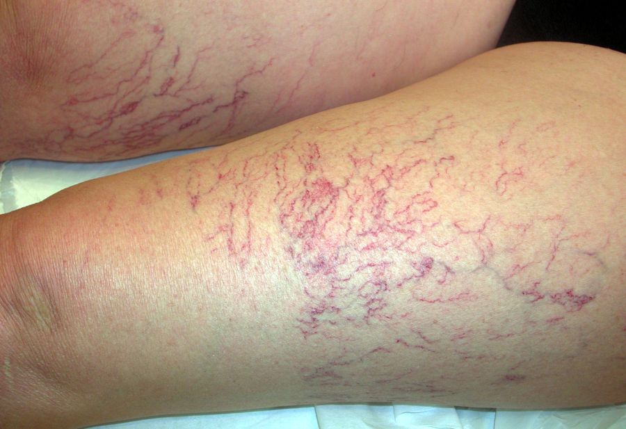 Telangectasie diffuse sulla coscia