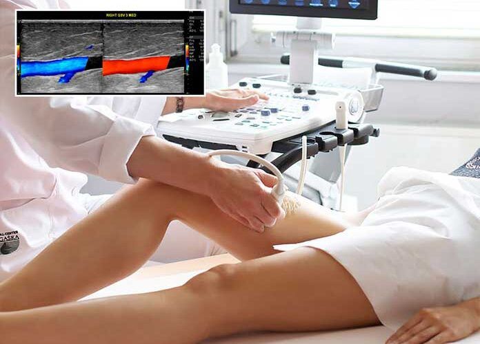 Esecuzione di un ecocolordoppler venoso sulla gamba di una paziente