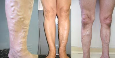 Tre gambe con quadri diversi di insufficienza venosa cronica