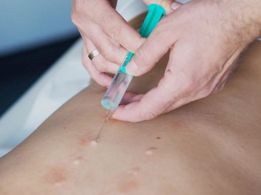 Iniezione intradermica di anestetico locale sulla schiena