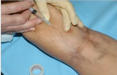 Iniezione sclerosante in una vena reticolare della gamba