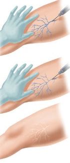Sequenza illustrata del trattamento sclerosante di un reticolo capillare