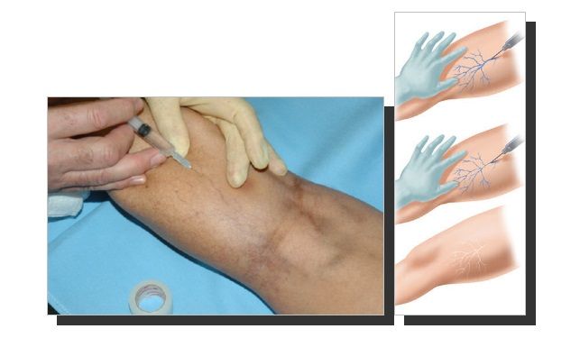 Iniezione di scleroterapia in una vena della gamba e schema del trattamento dei capillari
