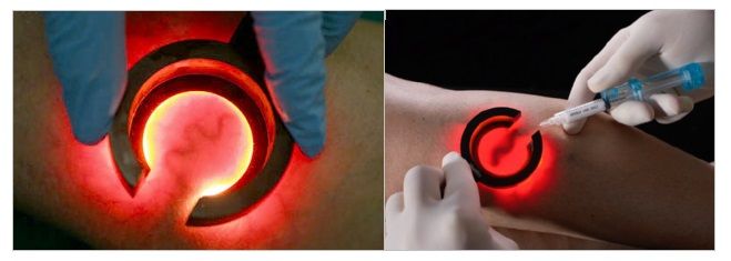 Transilluminazione dei vasi e iniezione guidata nella fleboterapia rigenerativa TRAP