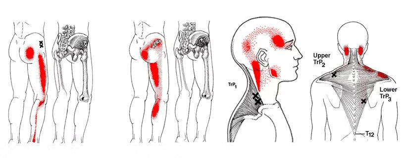 Mappe dei trigger point e delle zone di dolore riferito su bacino, collo e spalle