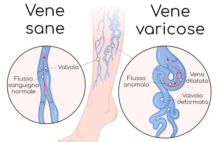 Schema del confronto fra vene sane e vene varicose, con valvola normale e valvola deformata
