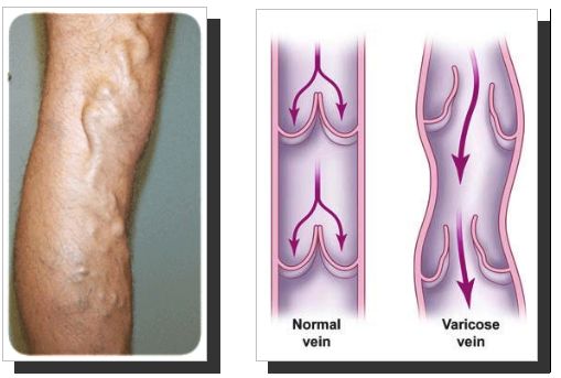 Vena varicosa sulla gamba e schema del confronto fra vena normale e vena varicosa